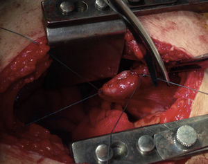 Exposure and suture of diaphragm tear; bleeding was already controlled.
