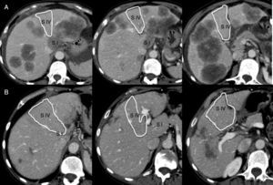 Preoperative study (CT scan) (A) upon diagnosis and (B) after neoadjuvant chemotherapy.