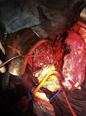 Transection line with tape for hepatic suspension and tourniquet for the right portal pedicle.