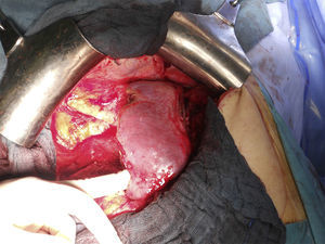 Liver remnant after both surgical interventions.