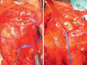 (A) Surgical field with the partially dissected tumour; (B) surgical field with the tumour resected. AB: brachiocephalic artery; ACCI: left common carotid artery; VBI: left brachiocephalic vein; T: tumour.