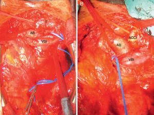 (A) Surgical field with the partially dissected tumour; (B) surgical field with the tumour resected. AB: brachiocephalic artery; ACCI: left common carotid artery; VBI: left brachiocephalic vein; T: tumour.