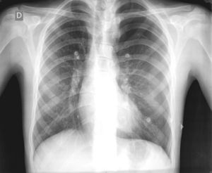 Chest X-ray at forced expiration showing evidence of left pneumothorax.