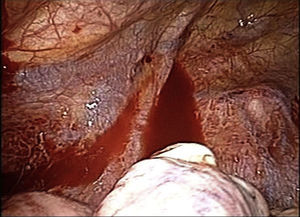 Exploratory thoracoscopy showing evidence of ampullae in the left apex.