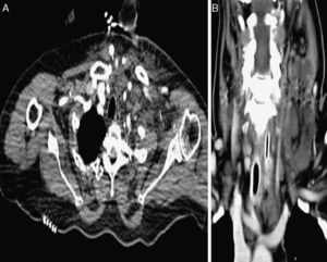 (A) Computed tomography of the neck with oedema and left cervical stranding at admittance; (B) after administering factor granulocyte-colony stimulating factor, with the formation of deep cervical abscesses.