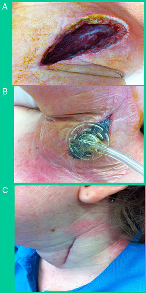 (A) Debridement using a left oblique lateral cervical incision after drainage and evacuation; (B) application of vacuum-assisted closure therapy at the site of the cervical debridement, mid-way through treatment (day 7); (C) results 27 days after discharge and 3 months after hospital admittance.
