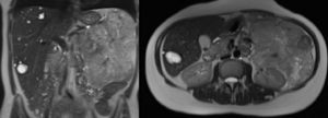 Abdominal MRI: retroperitoneal mass in close contact with the body and tail of the pancreas, and left kidney.