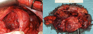 Macroscopic images of the procedure; en bloc resection of the tumour.