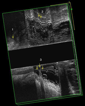 EEUS during strain and with ultrasound gel. Sagital plane. (1) Anal canal; (2) rectocele and (3) intussusception.