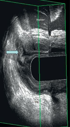 EEUS during strain. The arrow shows the presence of enterocele. PR: puborectal muscle.