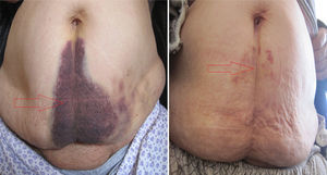 Periumblical ecchymosis of SRSH (before and after treatment).