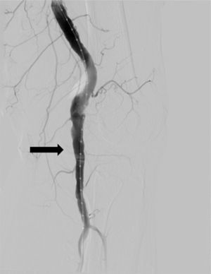 Left popliteal aneurysm crossing the medial joint line (arrow).