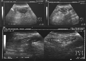 Ultrasound showing a structure compatible with the appendix in the subhepatic region.