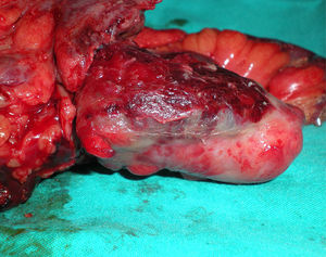 Surgical specimen with inflamed appendix.