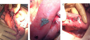 (A) Extensive small bowel areas with adhered AC plaque; (B) AC plaque on small bowel loops with erythematous area around the plaque; (C) bowel ulcer after the removal of the AC plaque.