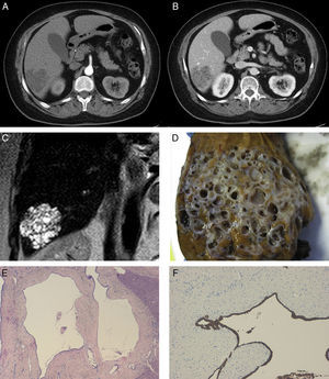 (A) Abdominal CT in arterial phase; (B) abdominal CT in portal phase with hypodense image in liver segment VI and mild intratumour contrast uptake forming septa in portal phase; (C) MRI image in T2 showing a hyperintense tumour in segment VI; (D) macroscopic image of the lesion showing the typical beehive pattern of a multicystic lesion with interposed liver parenchyma; (E) microscopic image (×4) showing dilated ductal structures with fibrosis and chronic periductal inflammation; (F) microscopic image with immunohistochemistry staining positive for CK7 and CK19.
