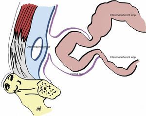 Schematic diagram of the reduction en masse phenomenon: the small bowel loop was incarcerated in the hernia sac located within the preperitoneal space.