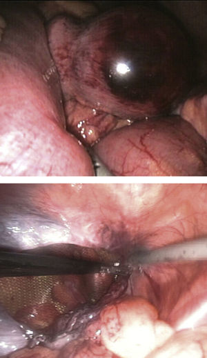 Reduction and exploration of incarcerated small bowel segment and hernia repair by means of transabdominal preperitoneal hernioplasty (TAPP technique).