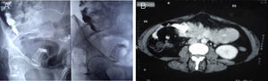 (A) Fluoroscopy demonstrating the gastric band in the area of the right iliac fossa; (B) cross-sectional CT scan of the abdomen and pelvis showing the gastric band within the intestinal lumen.