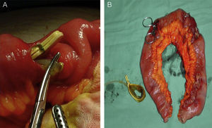 (A) Segment of ileum perforated by the gastric band; (B) complete surgical specimen showing several perforations.