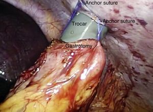 Insertion of the trocar in the stomach.