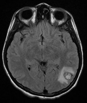 Magnetic resonance showing a metastatic nodular lesion in the second and third left temporal gyri.