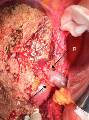 Left hepatectomy for Klatskin's tumour, with resection of the portal vein: (A) right hepatic artery of the upper mesenterium; (B) portal vein.