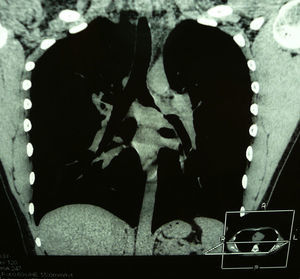 Coronal reconstruction of the thoracic CT scan showing a well-defined mass encompassing the left main bronchus.