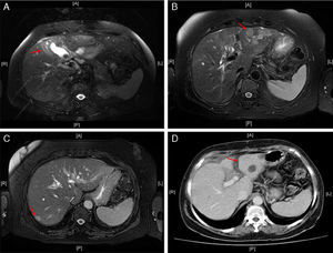 (A) Magnetic resonance in T2: irregular thickening of the gallbladder wall with inflammatory changes in the adjacent liver parenchyma; (B) magnetic resonance in T2: nodular lesion in liver segment II; (C) magnetic resonance in T2: nodular lesion in liver segment VI; (D) abdominal CT with contrast: absence of nodular lesion previously described in liver segment II.