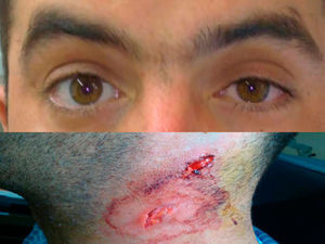Upper image: anisocoria with miosis of the left eye and ipsilateral ptosis. Lower image: cervical lacerated contusion.