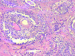 Sclerosing mucoepidermoid carcinoma with eosinophilia in Hashimoto's thyroiditis; microscope image showing the scale-like pattern of the tumour nests, presence of mucous cells, very collagenised fibrous stroma and the lymphocytic infiltrate with numerous eosinophils (haematoxylin-eosin 200×).