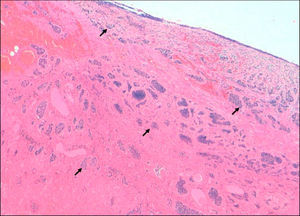 Neuroendocrine cell nests with transmural extension to the serosa.