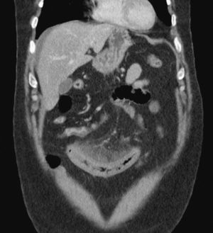 Computed tomography image: free fluid, congestion of the small bowel loop and rarefaction of mesenteric fat.