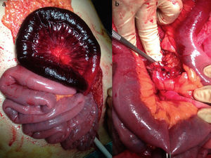 Intraoperative findings: venous ischemia (a) and venous thrombosis in the mesenteric section (b).
