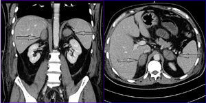 Bilateral adrenal nodules compatible with bilateral AH (right: 42mm×24mm; left: 45mm×25mm).