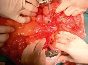 270° rotation of the colon due to the retrovascular passage of the first jejunal loop; varices on the mesenteric edge of the terminal ileum.