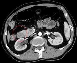 Axial CT in arterial phase: heterogeneous mass with areas of fat density in the second portion of the duodenum.