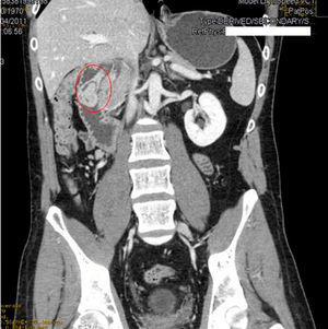 Coronal CT in portal phase: the pedunculated mass stemming from the first portion of the duodenum.