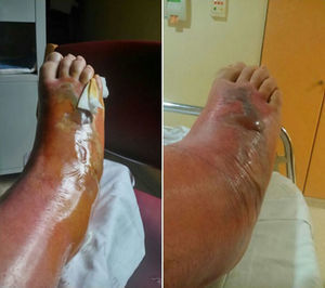 Between the 4th and 5th days: the degree of inflammation and oedema has advanced and cellulitis has progressed to the leg; large blisters have appeared containing serous fluid, and a central bloody blister has developed on the dorsal side of the foot.