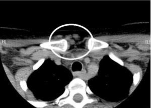 Cervical computed tomography showing subcutaneous nodules (circle).