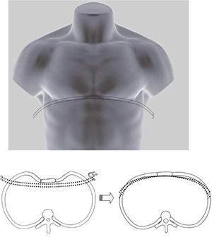 Diagram of the procedure. Once the bar has passed under the sternum it is turned to raise it.