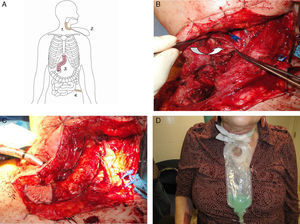 (A) First stage of the intervention: forearm free flap (1), saliva collection bag (2), failed interposition of the colon (3) and jejunostomy (4); (B) Dissection of the neck and identification of the pyriform sinus (arrow); (C) Forearm free flap forming a tube used to connect the pyriform sinus with neck skin; (D) Patient with saliva connection bag.