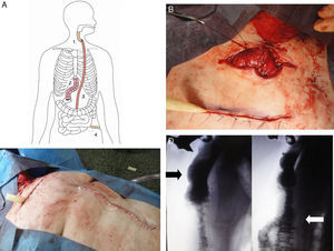 (A) Second stage of the procedure: forearm free flap (1), failed interposition of the colon (2), “supercharged” pedunculated jejunal flap (3), jejunostomy (4); (B) “Supercharged” pedunculated jejunal flap connected to the distal end of the forearm radial flap; (C) Midline laparotomy; (D) Barium swallow study showing re-established continuity of the digestive tube, forearm radial flap (black arrow) as well as the “supercharged” pedunculated jejunal flap (white arrow).