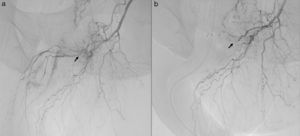(a) Angiography showing the passage of contrast material through the arteriovenous fistula; (b) angiography showing the obliteration of the arteriovenous fistula after embolisation.