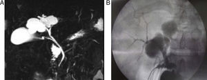 (A) Magnetic resonance cholangiopancreatography: choledochal cyst dependent on the bile duct; (B) intraoperative transcystic cholangiography.