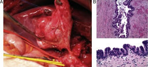 (A) Intraoperative macroscopic view of the choledochal cyst; (B) microscopic view showing micropapillary projections covered by cells with hyperchromatic nuclei with no evidence of stromal invasion.
