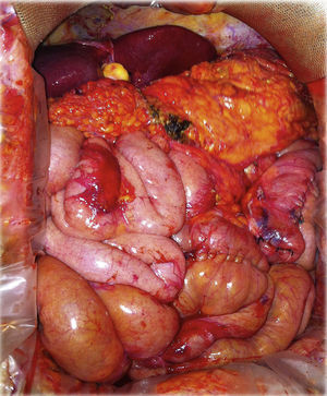 Final assemblage after reversal of the Scopinaro procedure and liver transplantation.