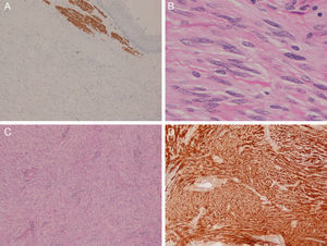 Microscopic images of the tumour: (A) positivity for desmin in the oesophageal muscle (above) and negativity in the tumour (below) (desmin, ×40); (B) high-magnification image showing nuclear morphology and absence of cytological atypia (HE, ×400); (C) low-magnification image showing the general appearance of the lesion (HE, ×100); (D) intense and diffuse staining for S100 protein (×100).