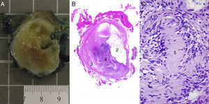 (A) Macroscopic appearance of the nodular lesion that is outlined from the muscle by a capsule; the interior has alternating myxoid-looking solid and cystic areas. (B) Microscope image confirming delimitation from the muscle,1 cystic areas2 and more solid eosinophil–myxoid areas3 and even more cellular areas.4 (C) In these, at higher magnification, the Verocay bodies of the schwannomas are identified, which are comprised by groups of filaments5 surrounded by rows of nuclei in the form of palisades.6