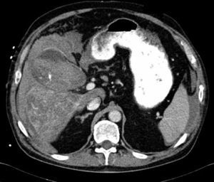 Abdominal CT scan: haemocholecystitis; active extravasation of gallbladder contrast.